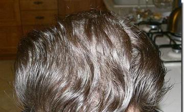 Hair restoration procedure results