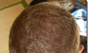 Hair restoration procedure results