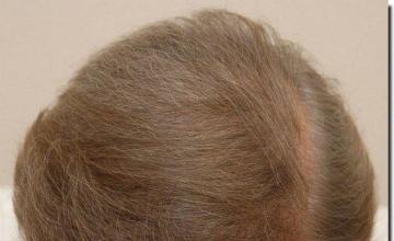 Hair restoration procedure results