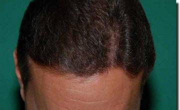 Hair restoration procedure results