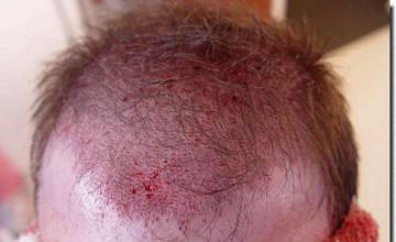 Hair restoration procedure results