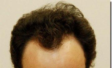 Hair restoration procedure results