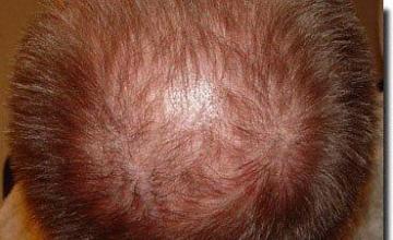 Hair restoration procedure results