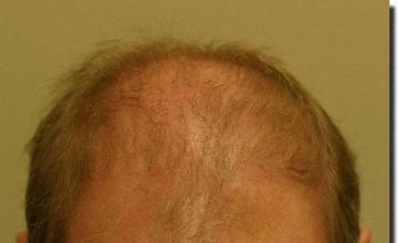 Hair restoration procedure results