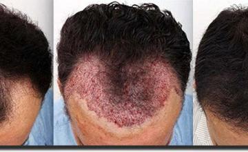 Hair transplantation surgery before and after photos