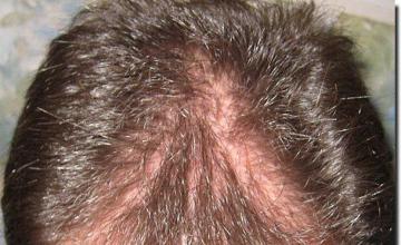 Hair restoration procedure results