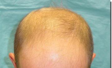 Hair restoration procedure results