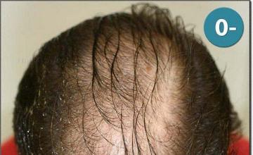 Hair restoration procedure results