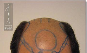 Hair restoration procedure results