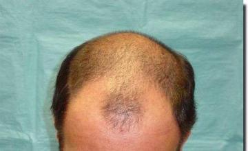 Hair restoration procedure results