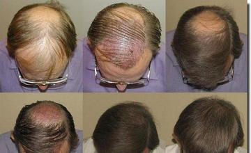 Hair restoration procedure results