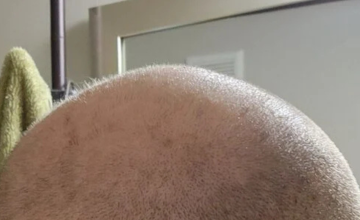 FUE extractions