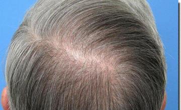 Hair restoration procedure results