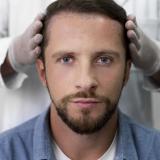 Modern Hair Transplants