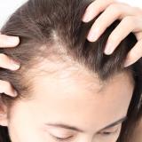 Female Hair Loss - Treatment and Restoration