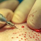 FUE – a new way of doing Follicular Unit Hair Transplantation