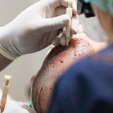 Ultra Refined Follicular Unit Hair Transplantation
