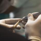 Follicular Unit Hair Transplantation - Step by Step