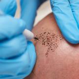 Scalp Micropigmentation (SMP)