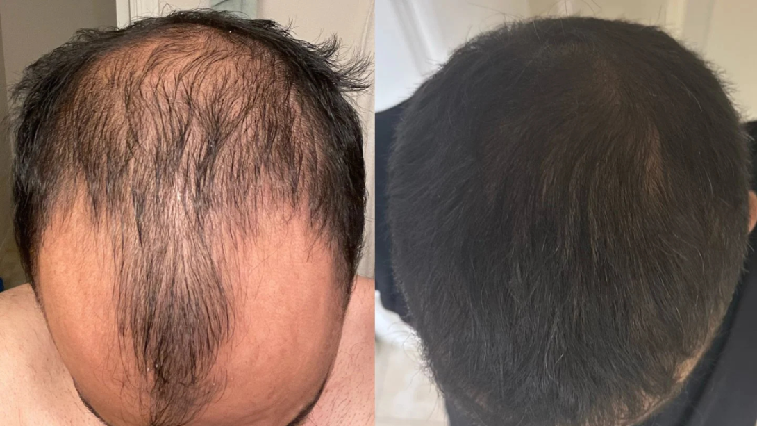 Dr. Ratchathorn Before and After
